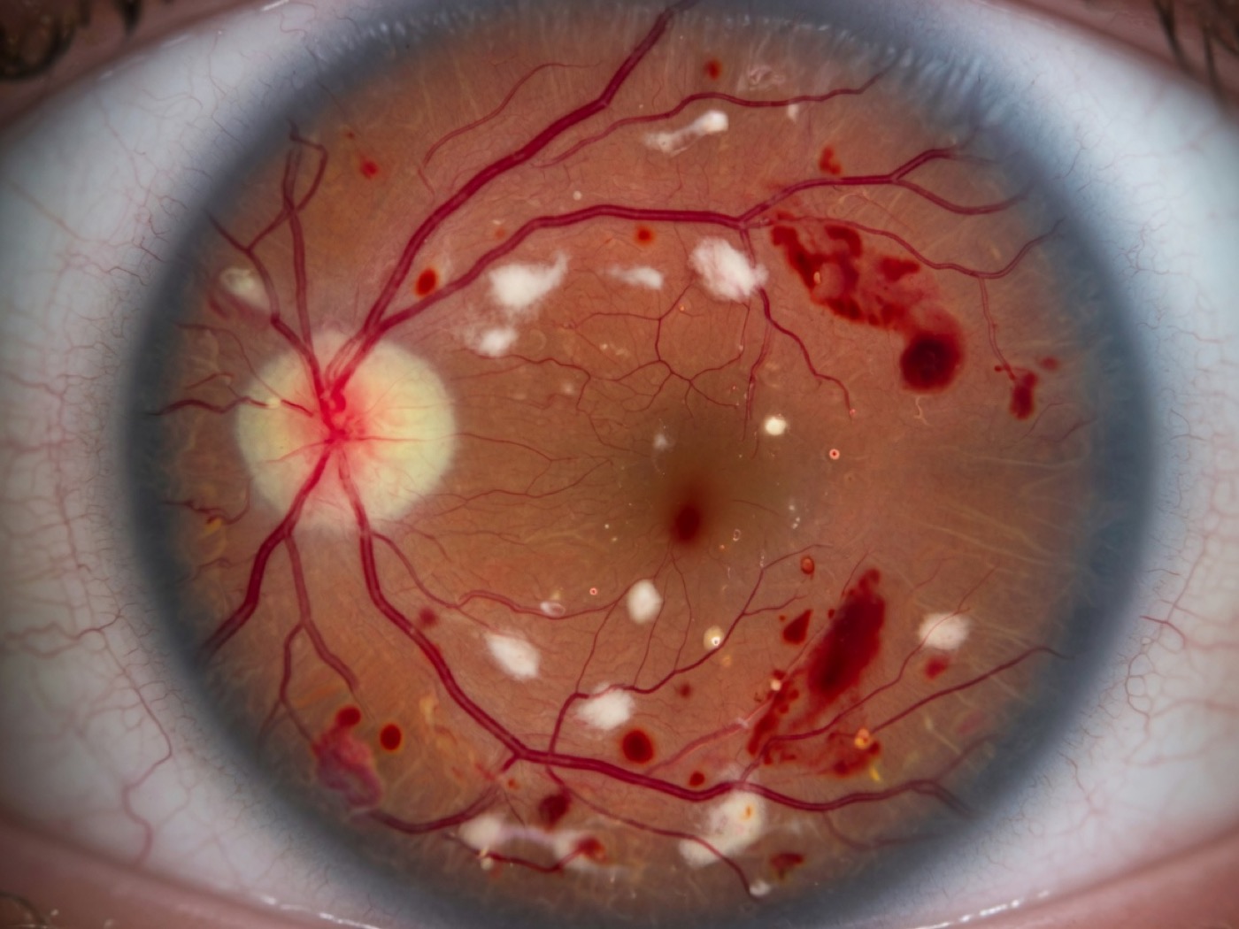 Vasos oculares em oclusão vascular da retina